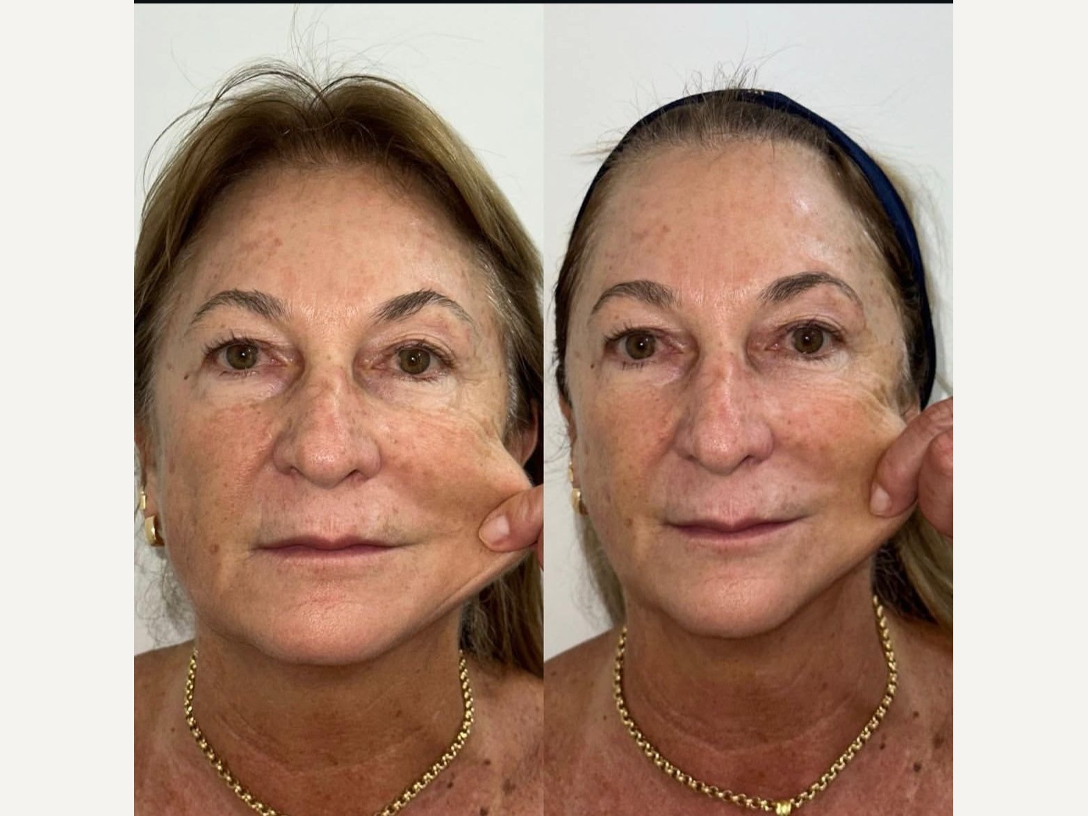 Antes e depois de paciente HiPRO, firmeza da pele do rosto