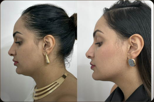 Antes e depois de paciente HiPRO, perfil com brincos