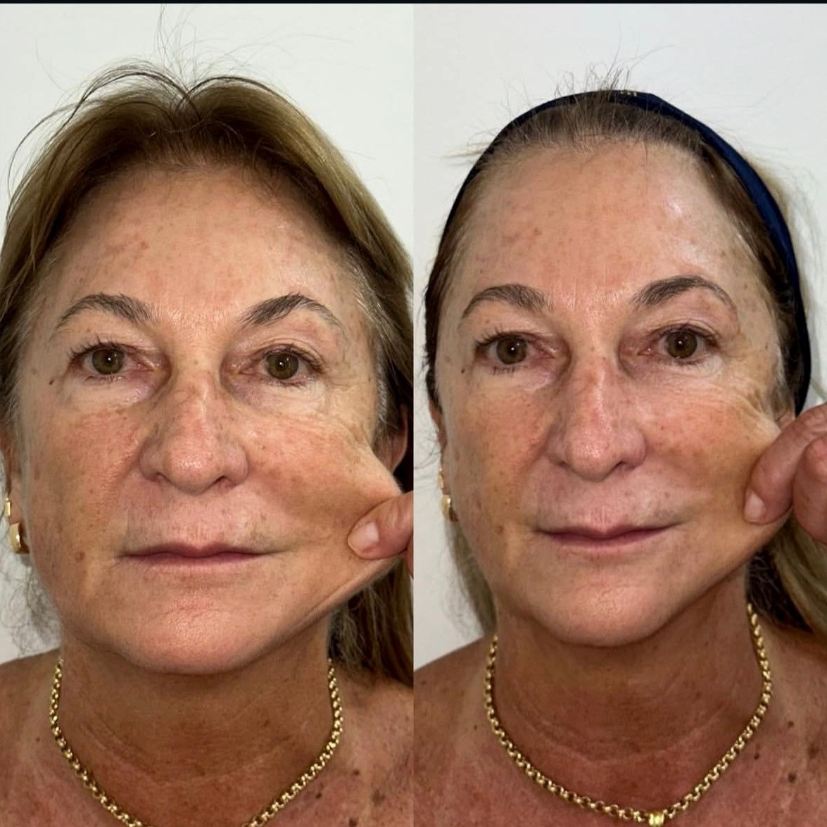 Antes e depois de paciente tratada com o protocolo HiPRO